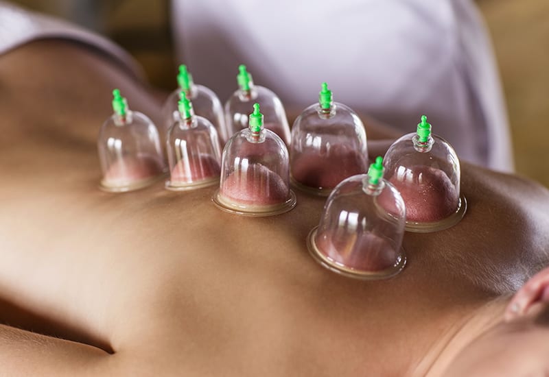 Cupping (ventouses)